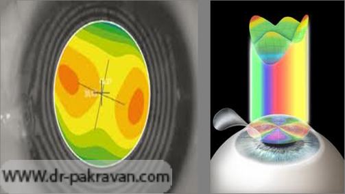 در ابرومتری (راست) تصویری سه‌بعدی از سطح قرنیه فراهم می‎شود در صورتی که در توپوگرافی (چپ) تصویر دو بعدی است.